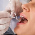 Microscopic Endodontics (Root Canals): The Comprehensive Guide to Saving Your Natural Teeth